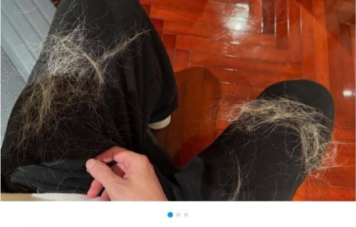 薛之谦满头斑秃和水泡，不值得同情，你也没资格心疼